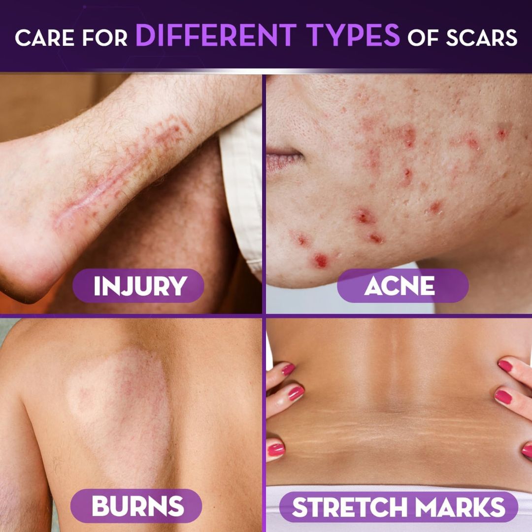 Skin & Doc Advanced Silicone Scar Gel - Clinically Proven Scar Reduction