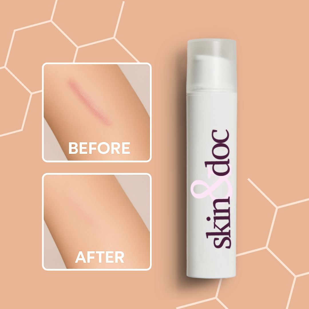 Skin & Doc Advanced Silicone Scar Gel - Clinically Proven Scar Reduction