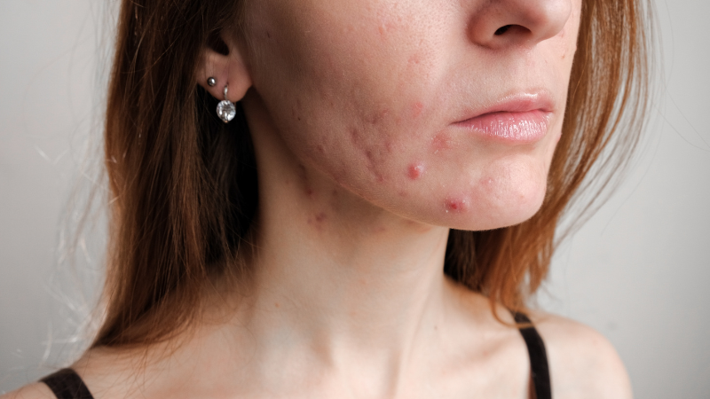 Skin & Doc | Skin and Doc | Skin Doctor | Skin Doc | Acne Treatment