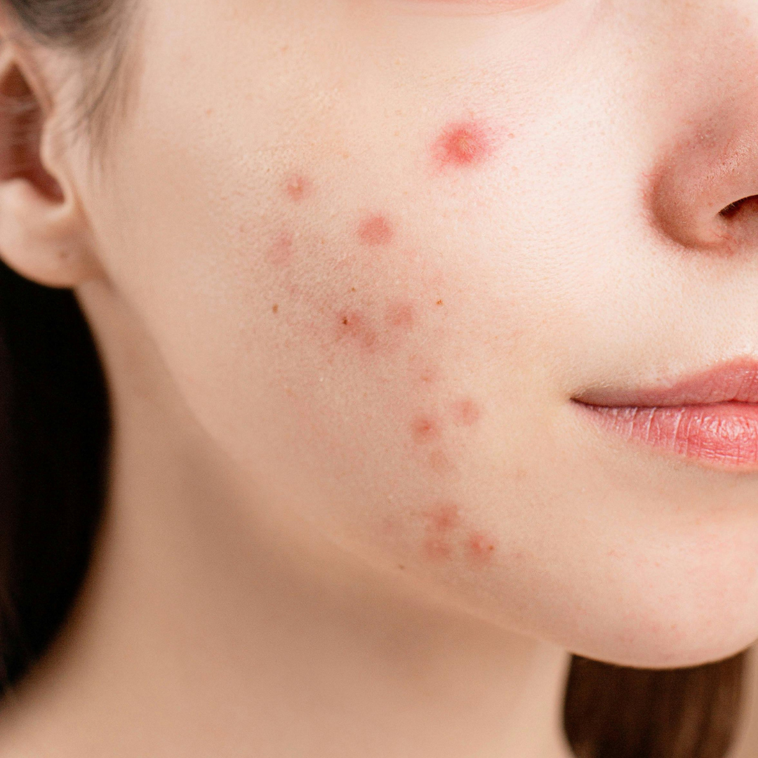 Acne Treatment Plan