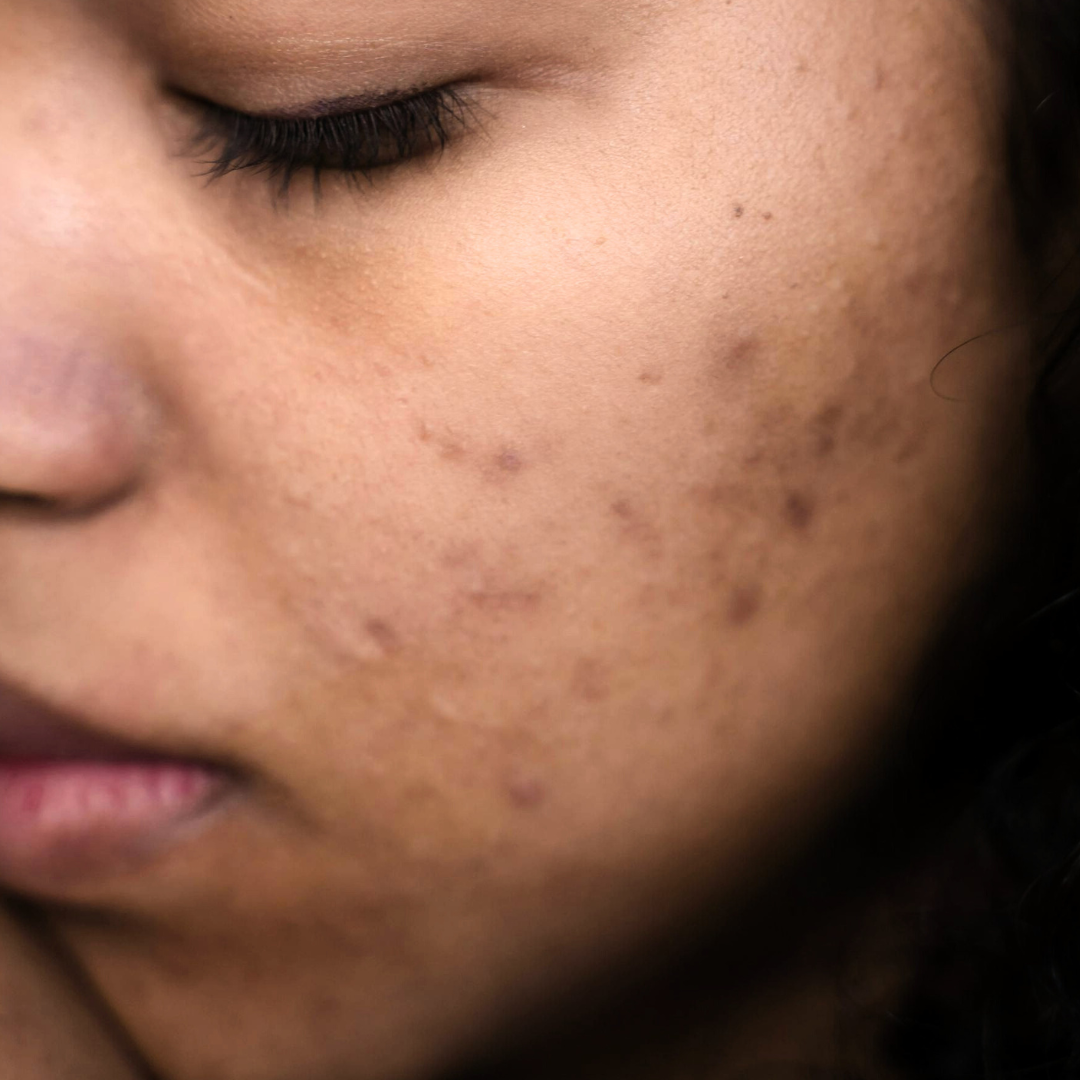 Dark Spots &amp; Hyperpigmentation Treatment Plan