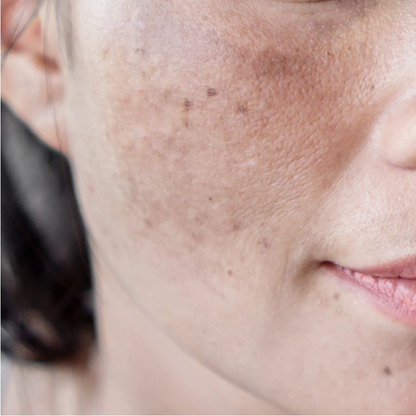 Melasma &amp; Dark Spots Treatment Plan