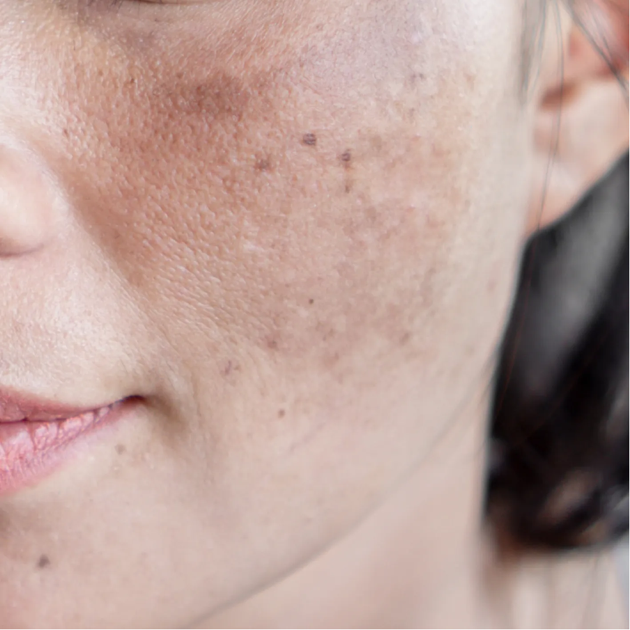 Skin &amp; Doc Melasma Discovery Offer (One Time)
